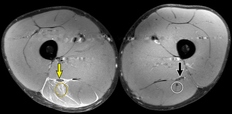 The Radiology Assistant Hamstring Injury