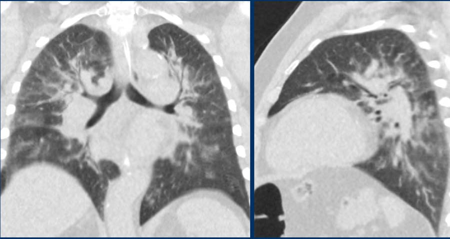 Pulmonary cardiogenic edema with centrally distributed groundglass, diffuse vascular enlargement, lymphnode enlargement and bronchial cuffing.