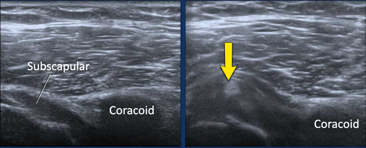 Image during exoratation (left) and endorotation (right)