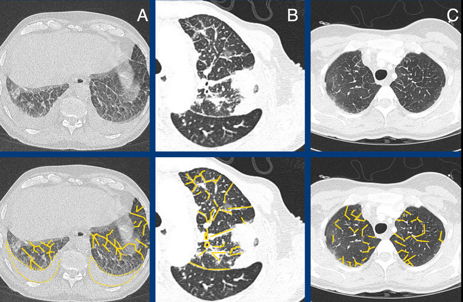 Pulmonary edema (A), Lymphangitic carcinomatosa (B), EGPA (C).
