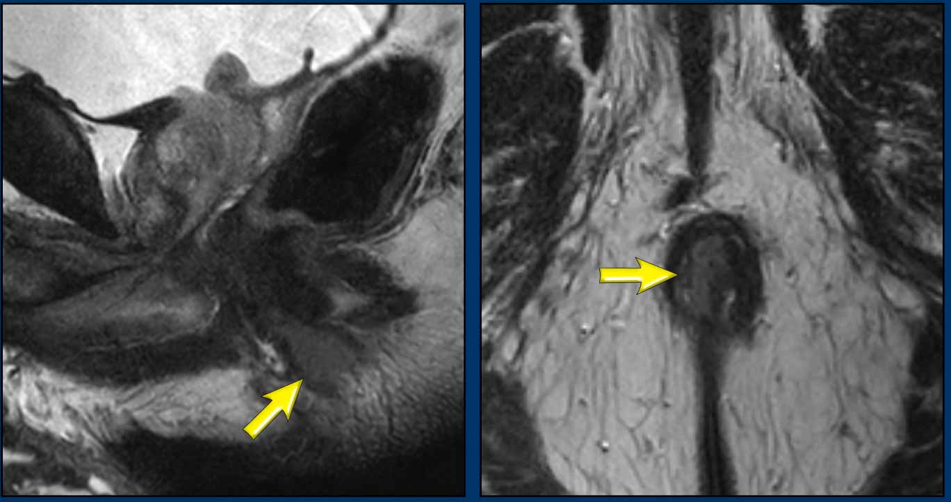 Anal tumor in the middle and lower third of the anal canal before treatment.