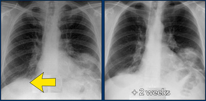 47-year old female patient treated for possible infection