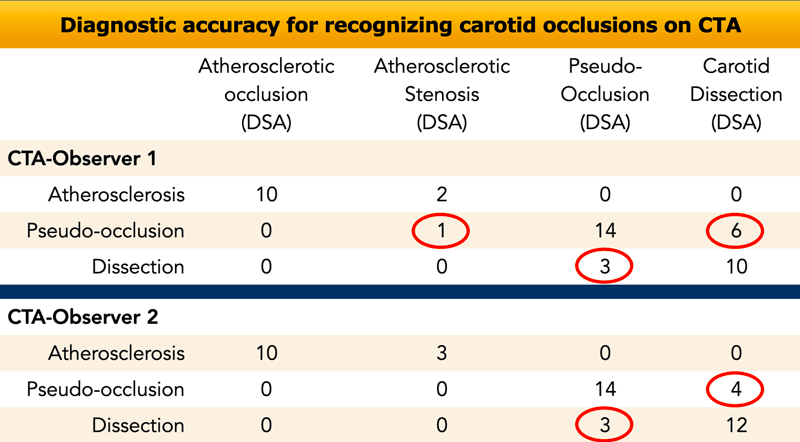 Study showing that differentiation between carotid dissection and pseudo-occlusion is difficult