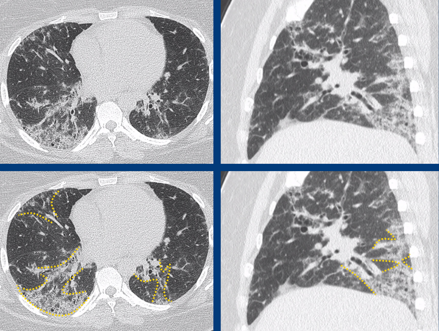 NSIP in Sjögren’s disease