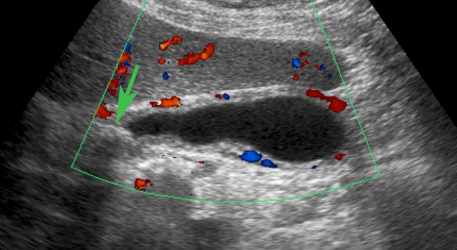 US performed 5 hours after the pain episode. There is both reperfusion edema and hyperemia of the gallbladder wall. The obstructing stone  (arrow) is still visible in the neck, but there was no hydrops