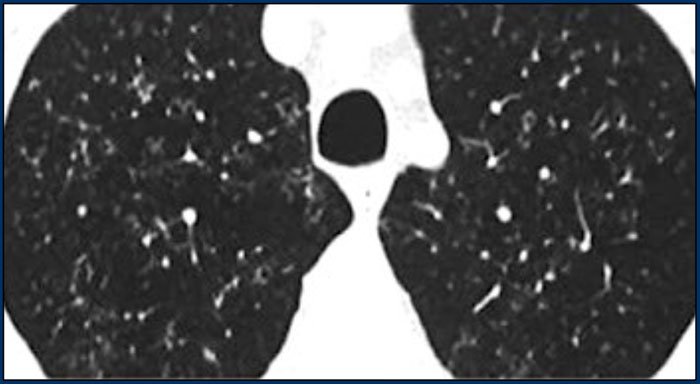 Early stage Langerhans cell histiocytosis with small nodules