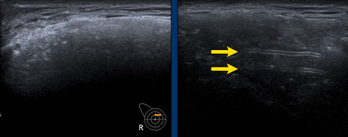 Stepladder sign in a patient with extreme capsular calcifications.