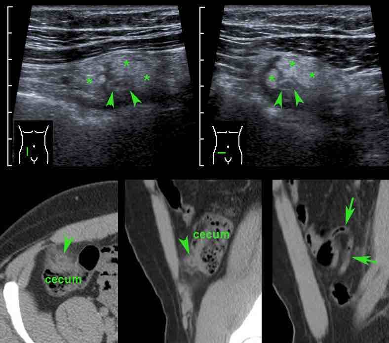 Epiploic appendagitis