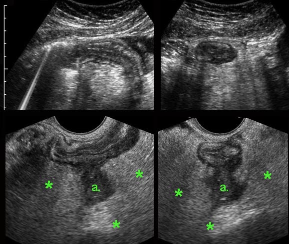 Abscess in Crohn’s disease.