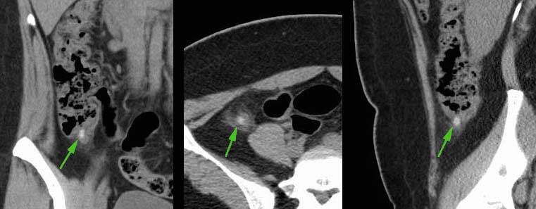 Stump appendicitis