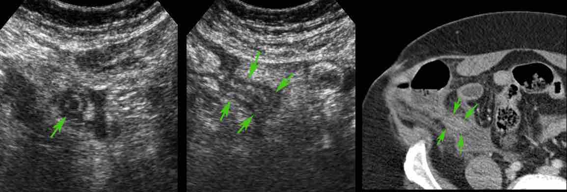 Stump appendicitis