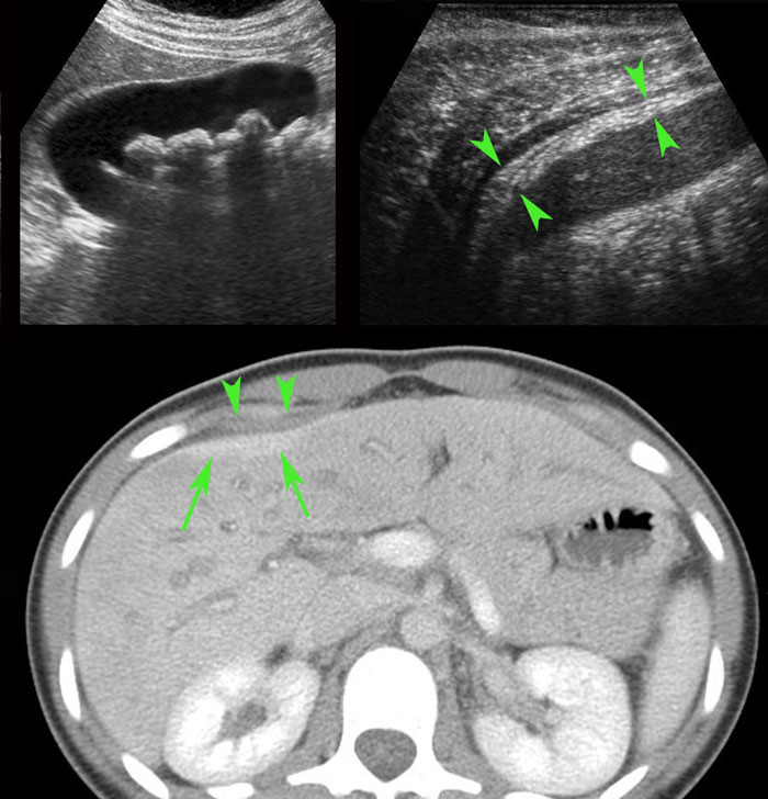 Fitz-Hugh-Curtis in patient with coincidental gallstones.