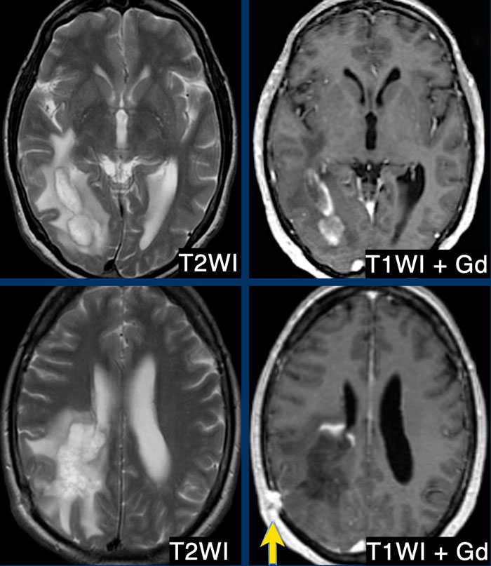 Tumefactive MS. Arrow indicates biopsy site.