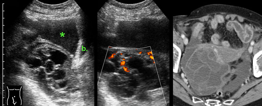 Ruptured benign mucinous cystadenoma.