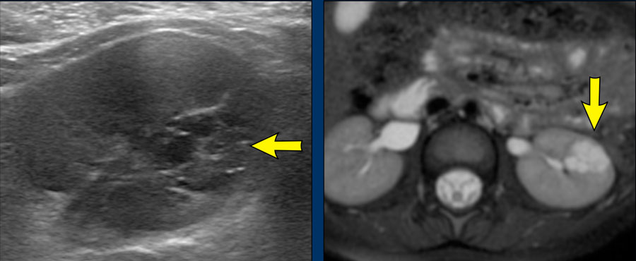 Cystic nephroma