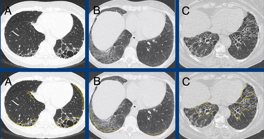 Subpleural dominant (A), subpleural sparing (B), and peribronchial dominant (C) patterns of fibrosis.
