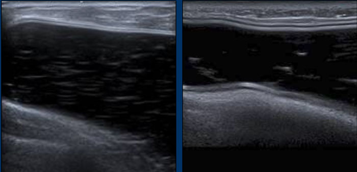 Normal inhomogeneous aspect postoperative