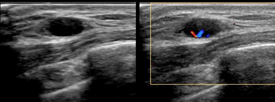 A normal intramammary lymph node