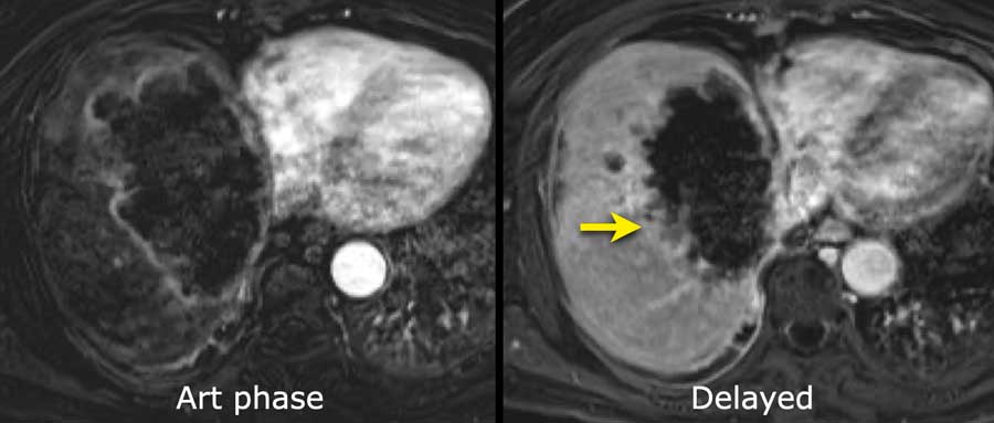 Cholangiocarcinoma