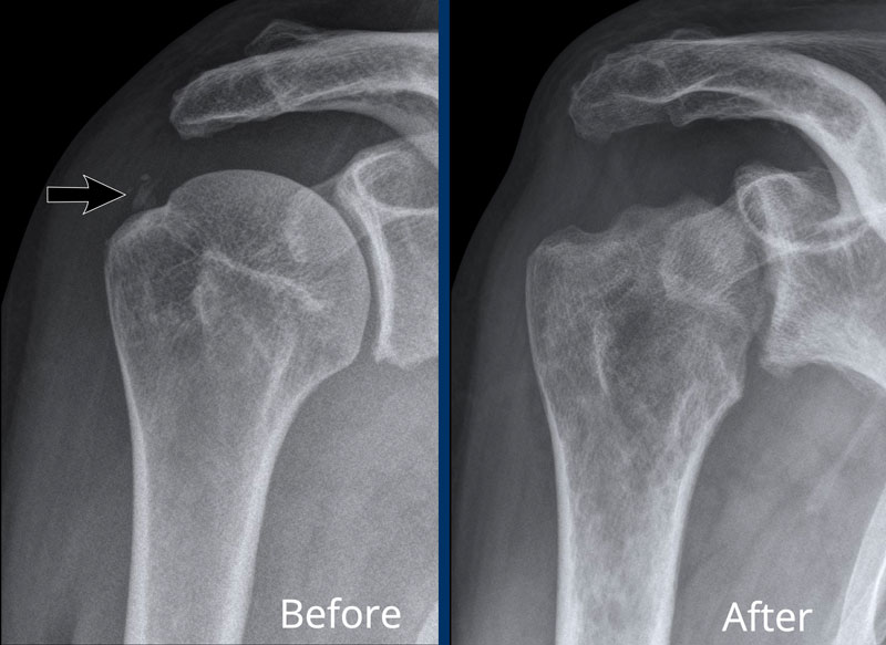Septic arthritis