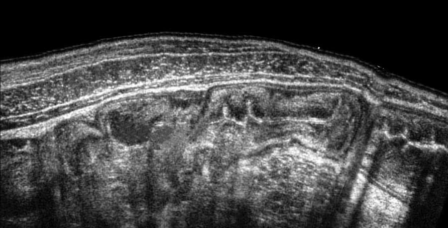 Thickening of mucosa and submucosa in Clostridium colitis