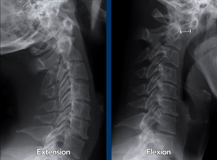 Atlanto-axial subluxation due to rheumatoid arthritis of the cervical spine