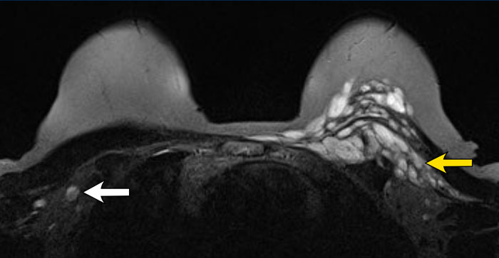 Residual Silicone after explantation