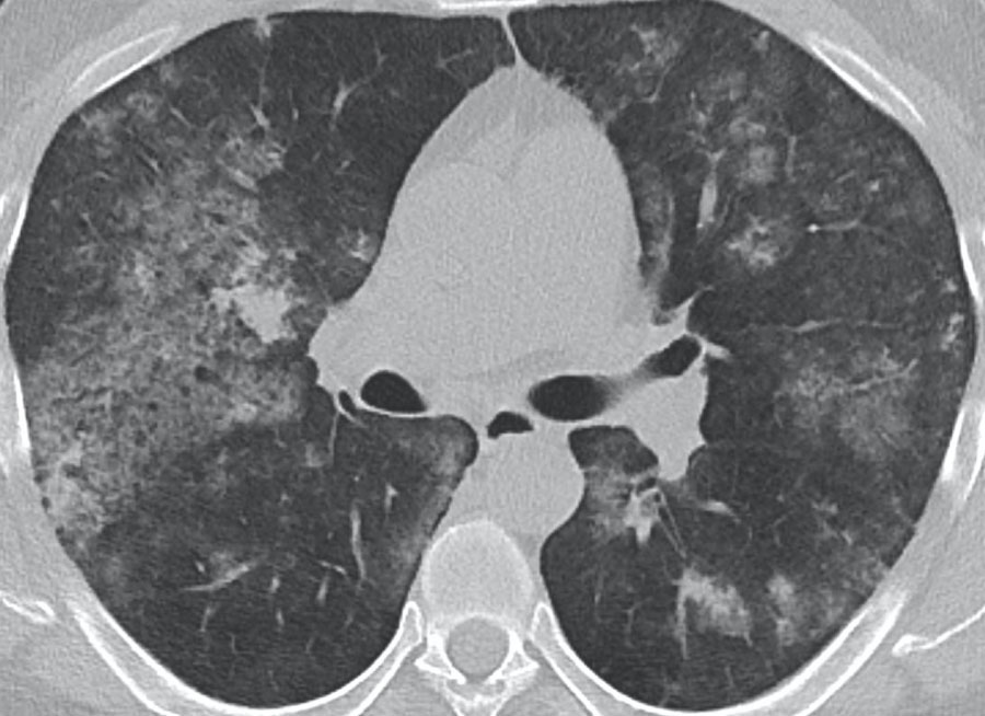 Alveloar hemorrhage in a patient with SLE.