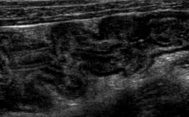 Diffuse thickening of bowel wall in a patient with colitis.