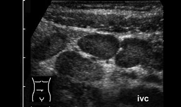 US shows enlarged mesenteric lymph nodes in the right lower quadrant, with no other abnormalities