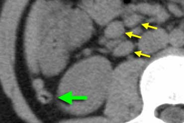 Normal appendix (green arrow) and enlarged mesenteric lymphnodes (yellow arrows).