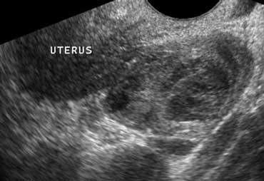 Enlarged adnex due to salpingitis