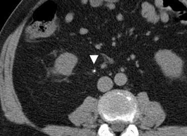 Small stone in right ureter (arrow) causing right flank pain.