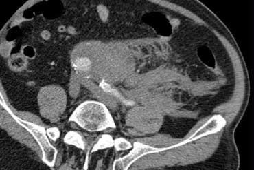 Left retroperitoneal fluid collection due to ruptured aneurysm.