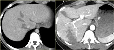 Liver lacerations