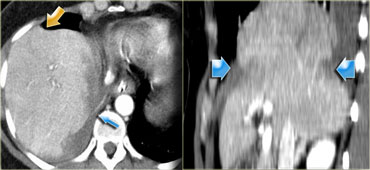 'Collar' sign in right-sided diafragmatic rupture