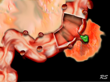 Illustration of a sigmoid diverticulitis