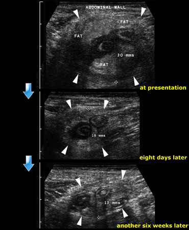 Resolution of an appendiceal phlegmon: At presentation, eight days later and finally another six weeks later.