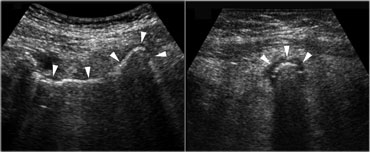 Pitfall. The inflamed appendix, demonstrated in the longitudinal (left) and axial (right) plane, has a gas-filled lumen (arrowheads), making it difficult to identify.The sausage shape and the inflamed fat are the clue to the diagnosis.