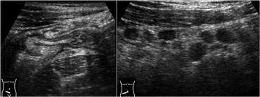 Infectious ileocecitis in a patient with clinical symptoms of appendicitis. There is marked mucosal and submucosal wall thickening of ileum and cecum.