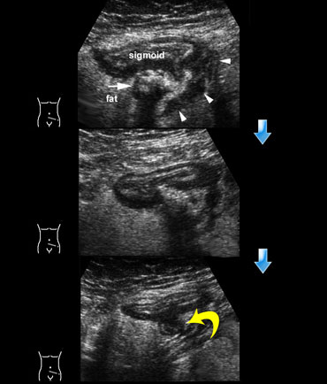 Sigmoid diverticulitis: Natural, benign course.