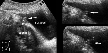 Colovesical fistula with air-track resulting from sigmoid diverticulitis