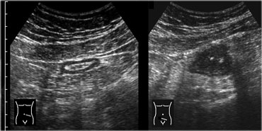 Normal sigmoid (left) cranial to sigmoid carcinoma (right).