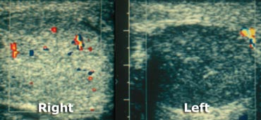 Testicular torsion: Optimal setting for color on normal side, followed by examination of symptomatic side.