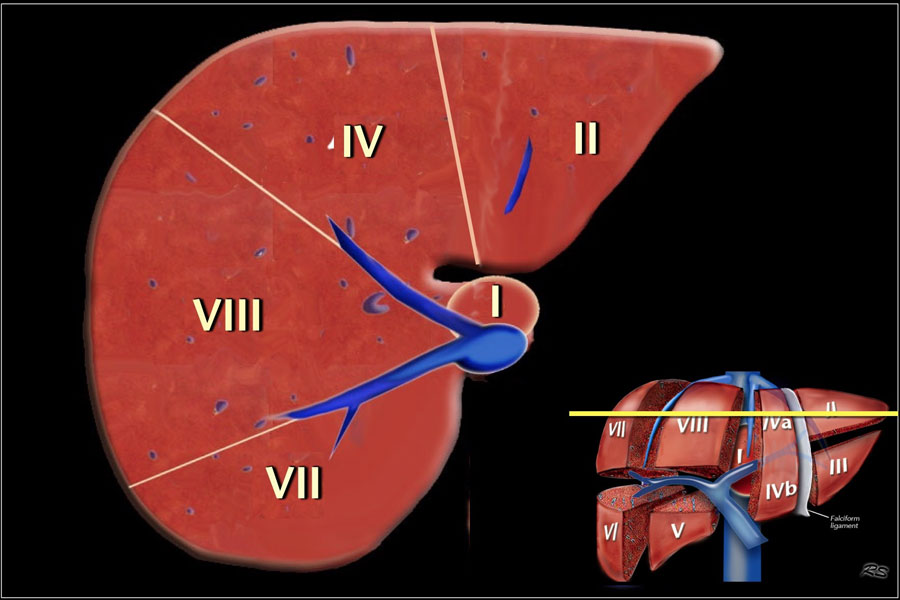 Image at the level of the superior liver segments.