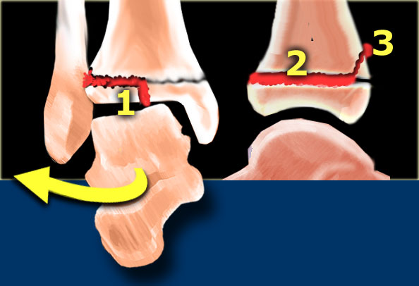 Triplane fracture