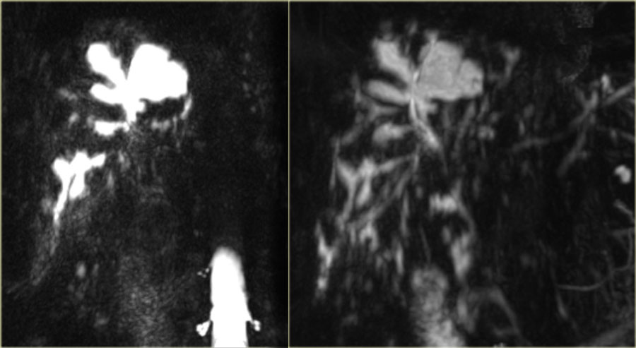Saccular intrahepatic duct dilatation with normal sized choledochal duct in Caroli disease