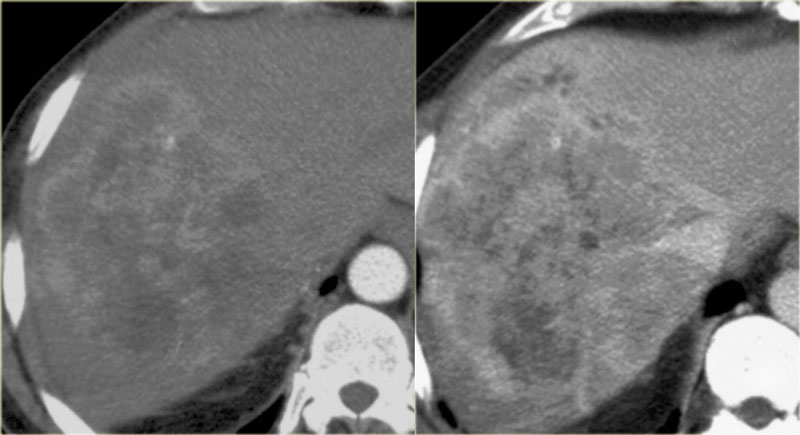 Early and late phase enhancement of a intrahepatic cholangiocarcinoma