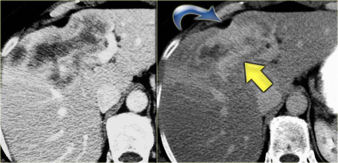 Intrahepatic cholangiocarcinoma. Capsular retraction and the late enhancement