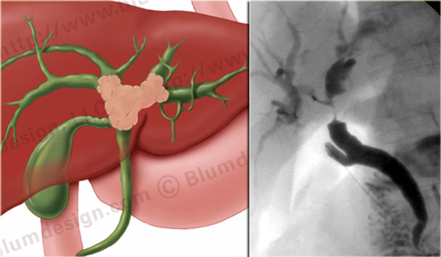 Bismuth-Corlette type IV Klatskin-tumor